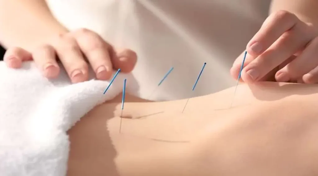 طب سوزنی