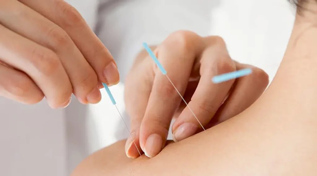 طب سوزنی